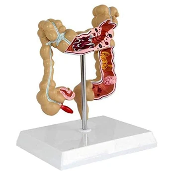 Colon Patologic De Cancer Colorectal Model Intestinul Gros Model Gastro-Anatomice Model